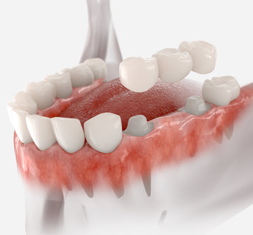 Dental Bridges