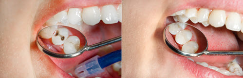 Composite Fillings