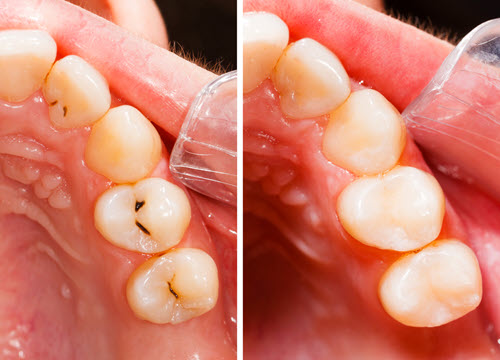 Composite Fillings