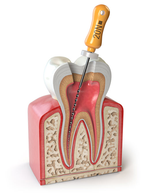 Root Canal