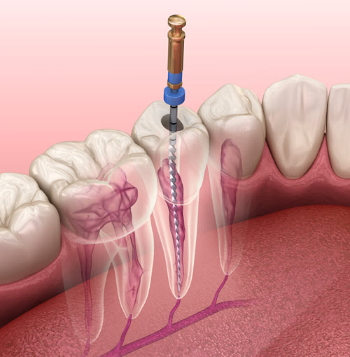 Root Canal