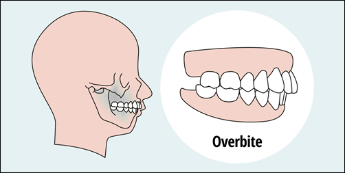 Overbites