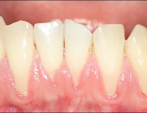 Correcting Gum Recession Before It Leads to Tooth Loss