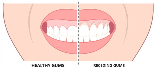 Gum Recession