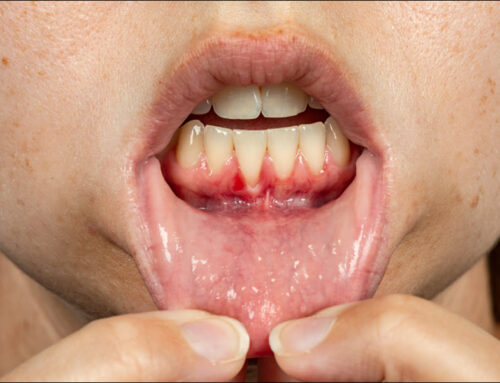 Gum Recession and Gum Disease