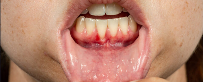 Gum Recession