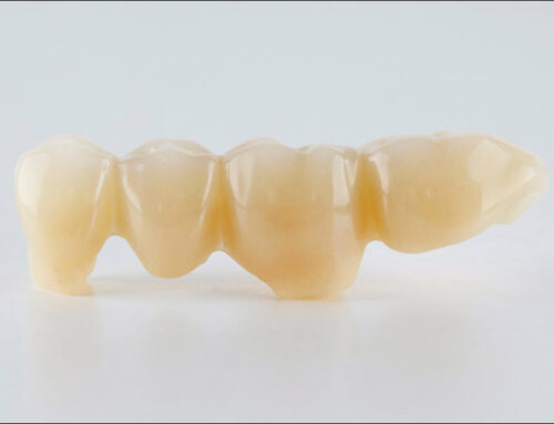 Cost vs. Longevity of Different Restorations
