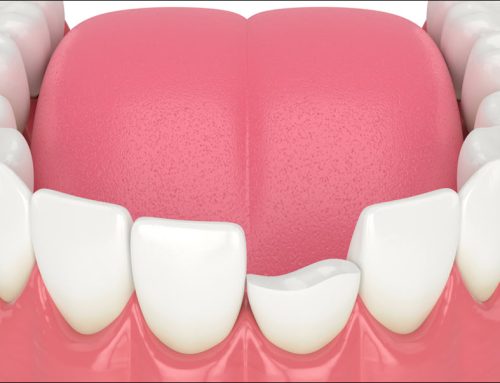 Preventing and Treating Injured Teeth: Protect Your Smile