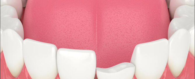 Injured Teeth